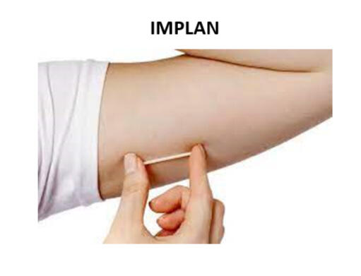 implan